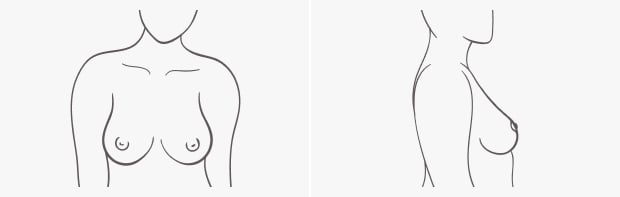 Breast shape Teardrop